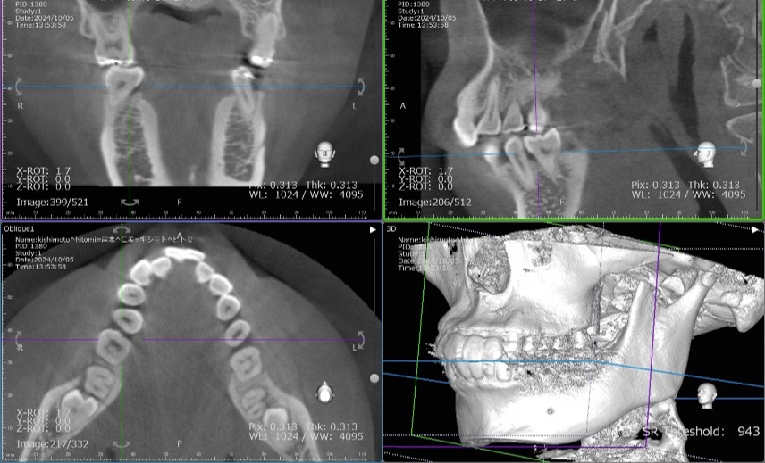 歯科用CT活用の重要性